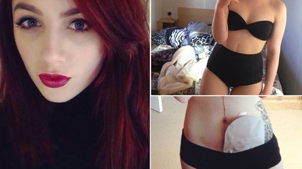 Vivir con una bolsa de colostomía Vivir con una bolsa de colostomía