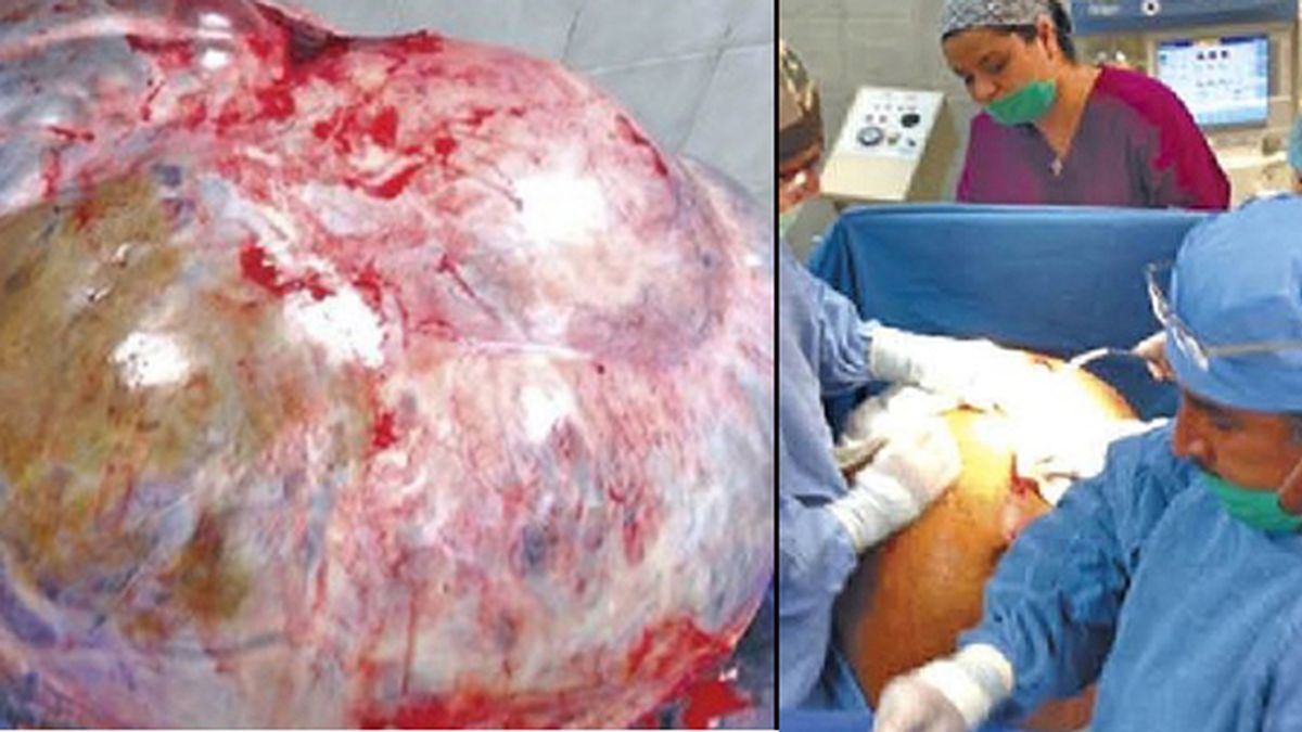 Extirpan un tumor de más de 60 kilos a una mujer en México