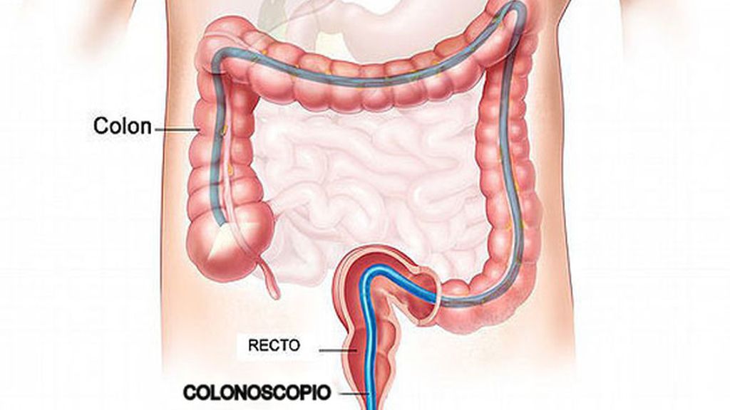 Las colonoscopias podrían prevenir el cáncer de colon en 