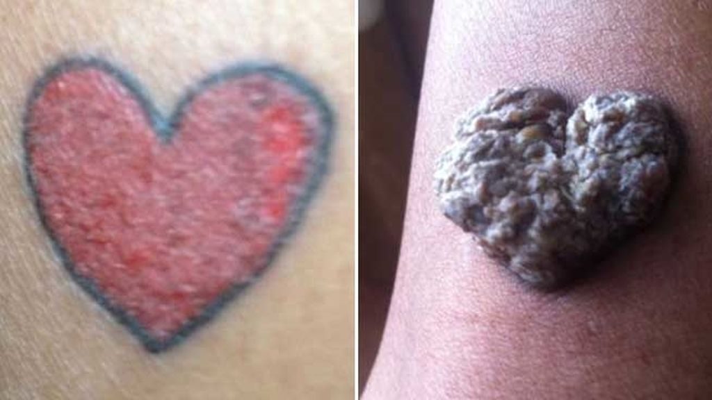 Una alergia a la tinta de un tatuaje le provoca una cicatriz de 4  centímetros de grosor