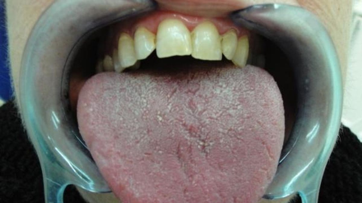 Un nuevo enfoque de la radioterapia reduce los síntomas de boca seca