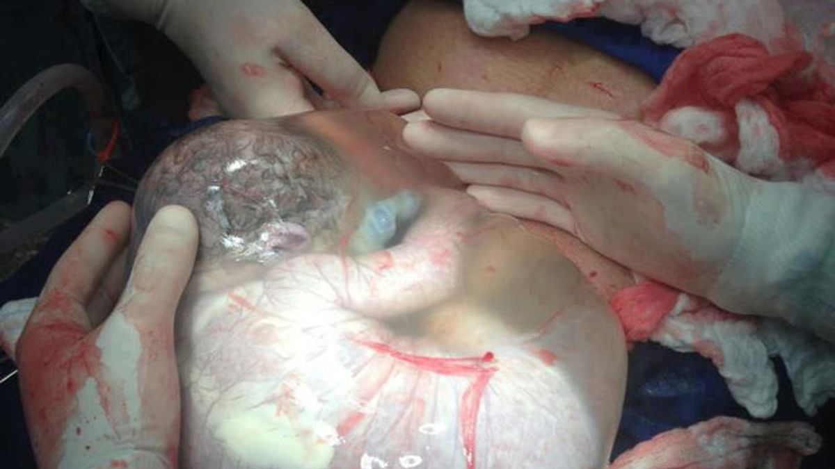 Bebé dentro del saco amniótico