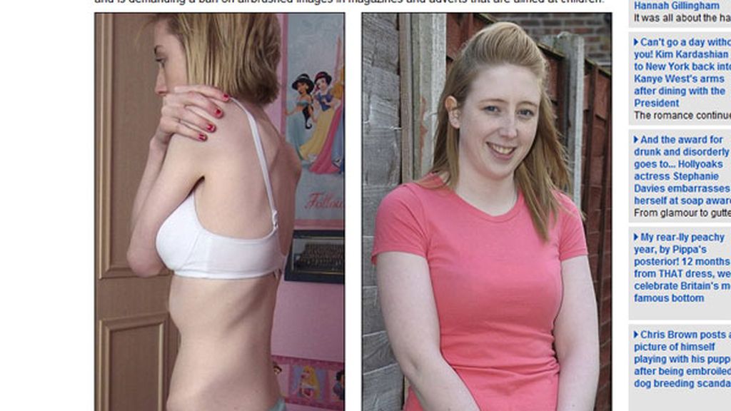 Anorexia