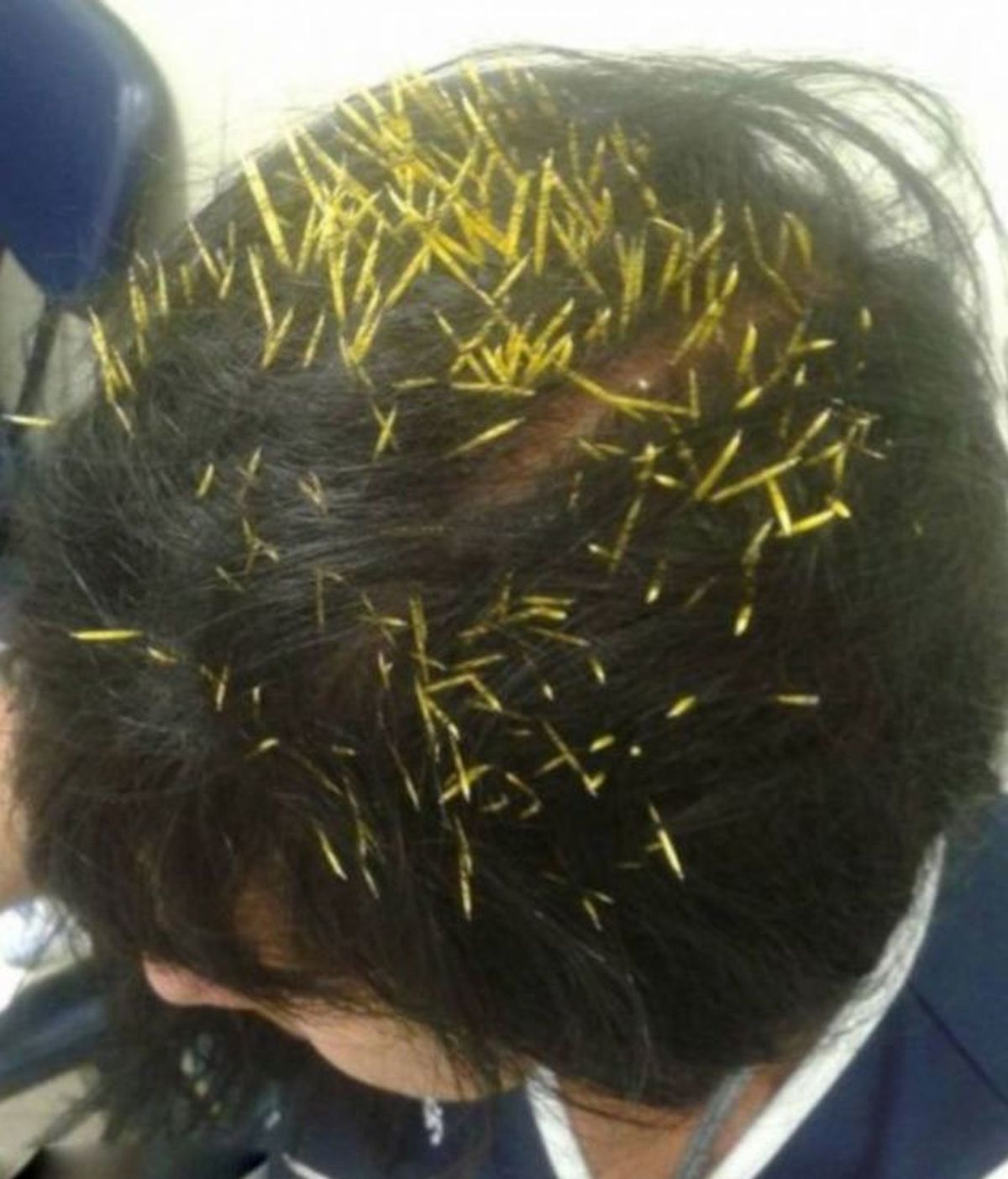 Una mujer atendida en Rio de Janeiro con 272 agujas de puercoespín en la cabeza