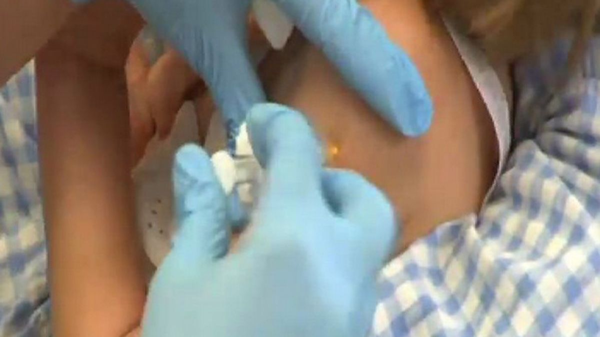 Vacuna de la varicela