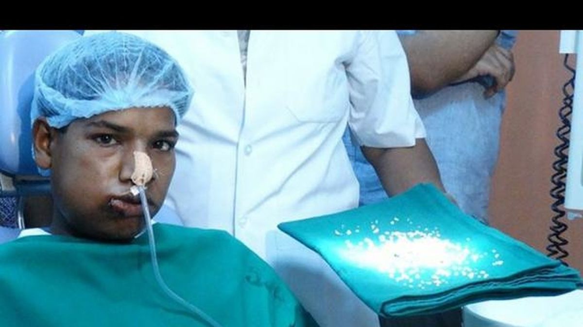 Le extirpan 232 dientes a un adolescente indio