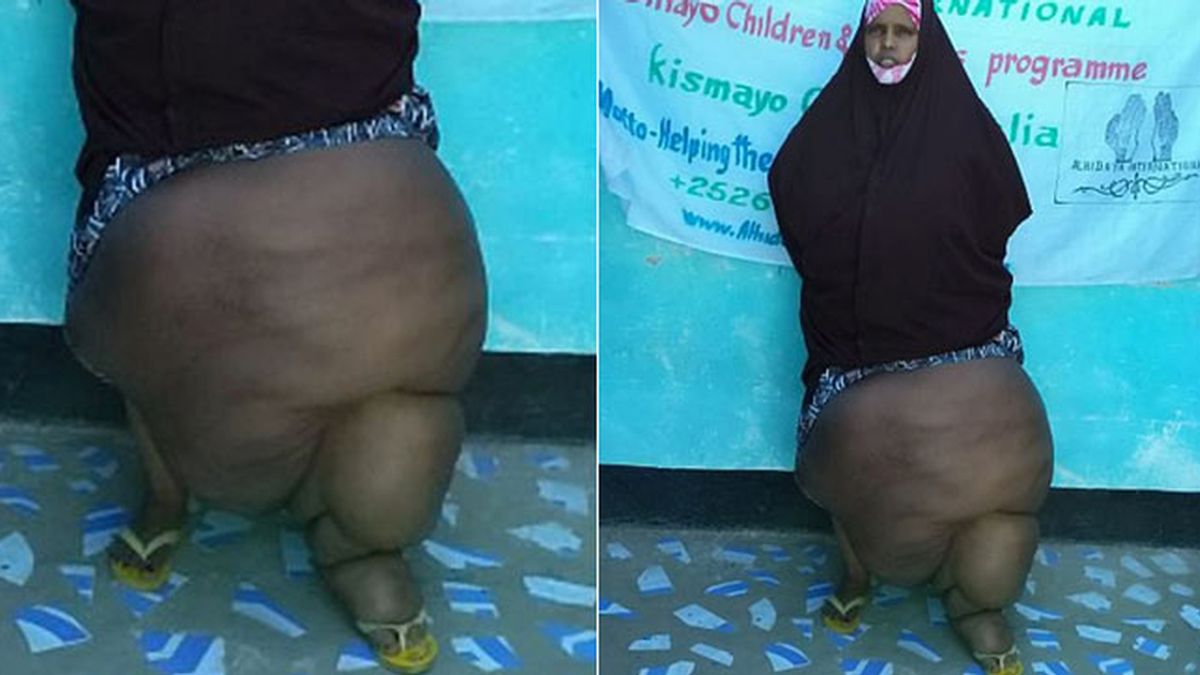 Sadia Abdinur, pierna de 32 kilos