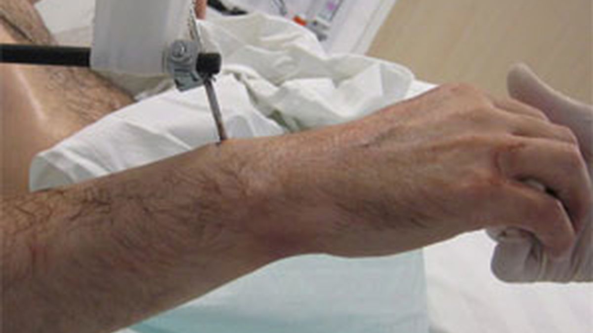 Imagen del brazo del paciente tras la intervención. Foto: EFE.