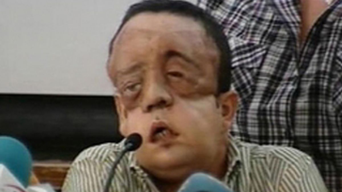 Comparecencia del segundo de cara transplantado en España