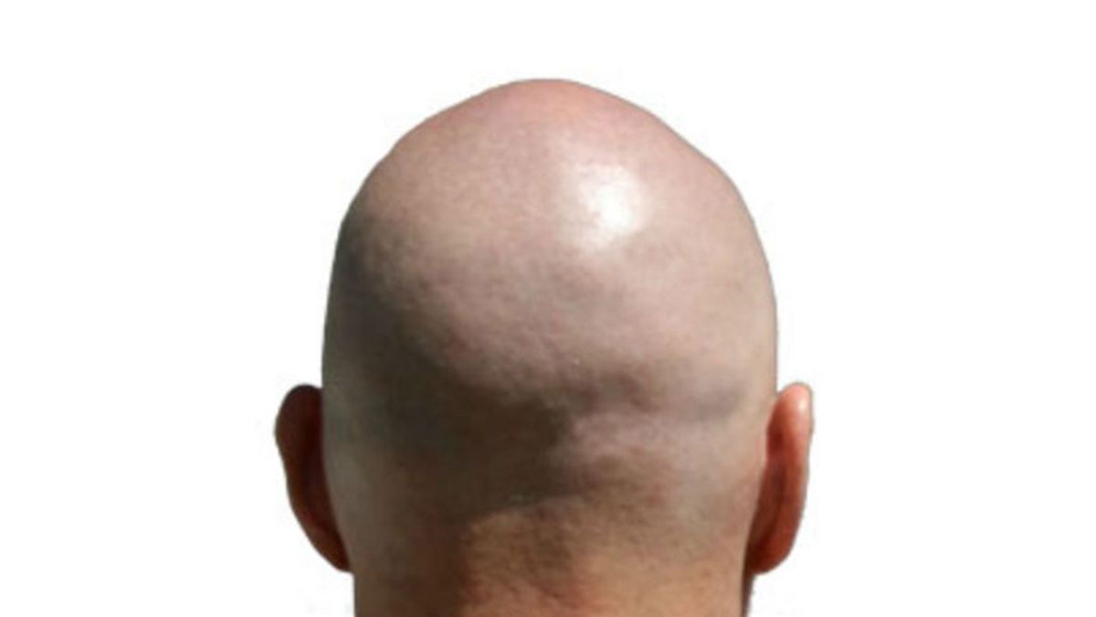 calvo, calvicie, alopecia, caída de pelo