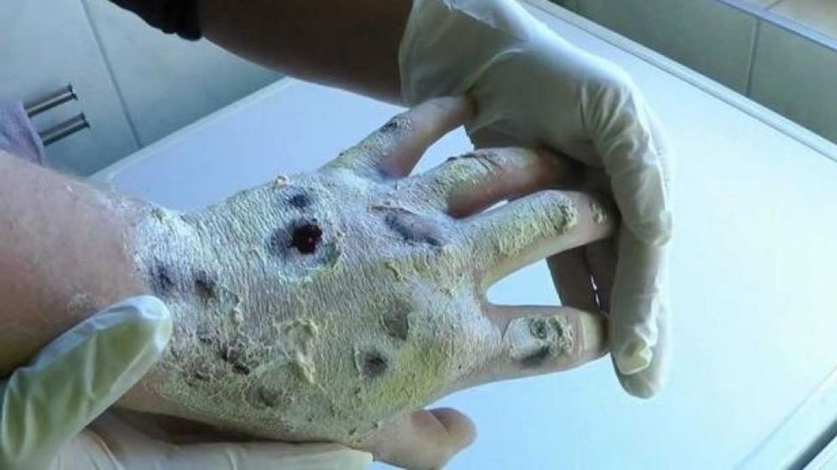 Llega a España el 'krokodil', la droga que 'te come vivo'