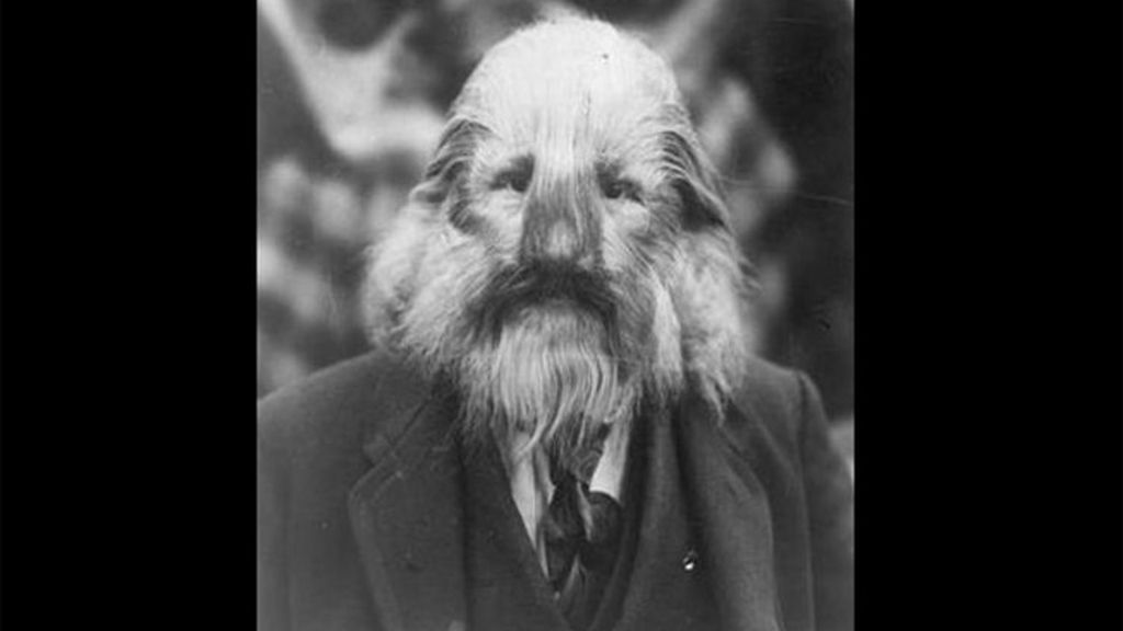 Lionel, 'El hombre con rostro de león'