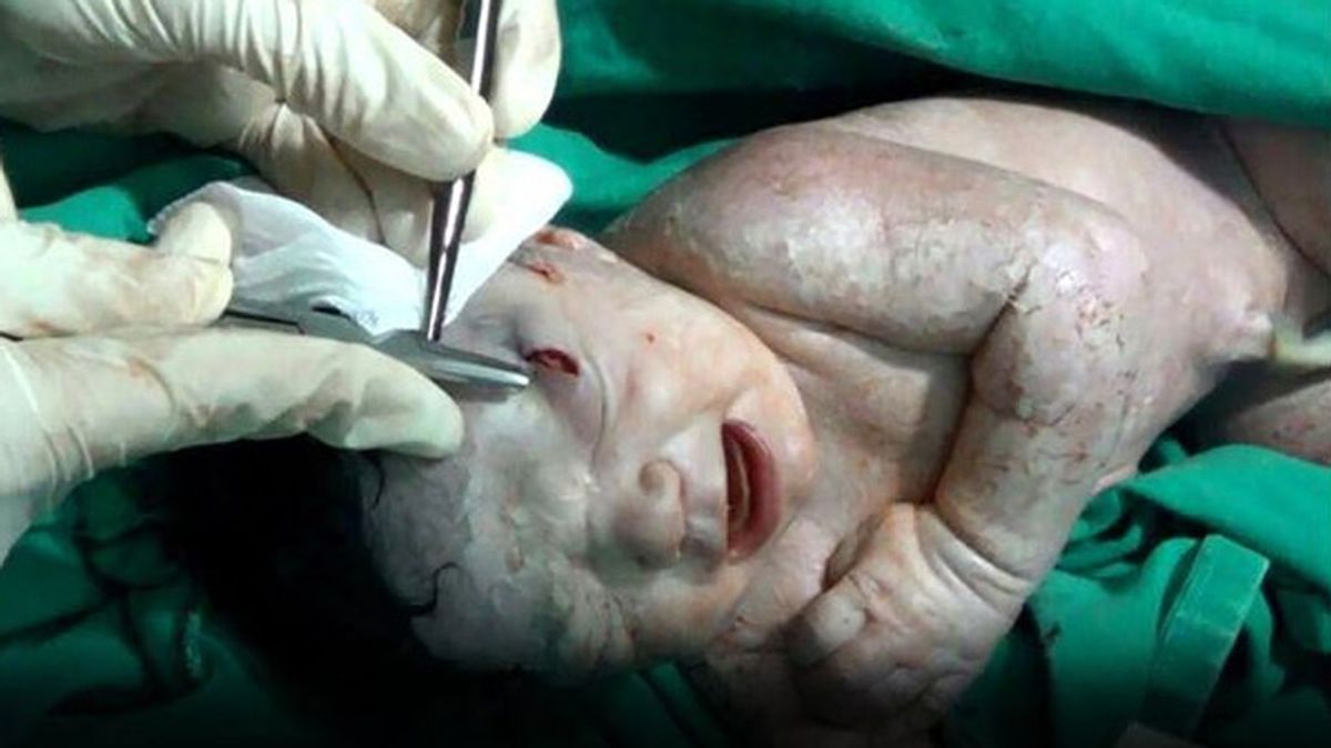 Amel, el bebé sirio que nació con metralla en la cabeza