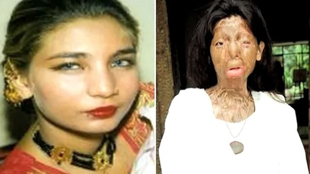 Fakhra Yunus, antes y después del ataque con ácido.