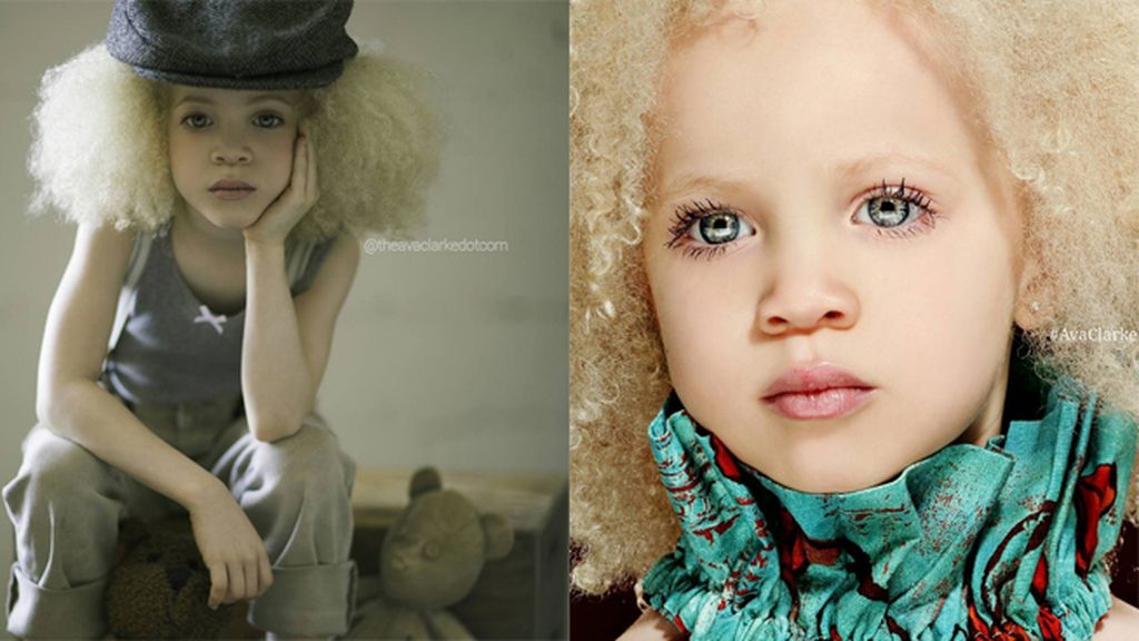 Ava es albina, sufre un trastorno genético que afecta los niveles de producción y distribución de melanina