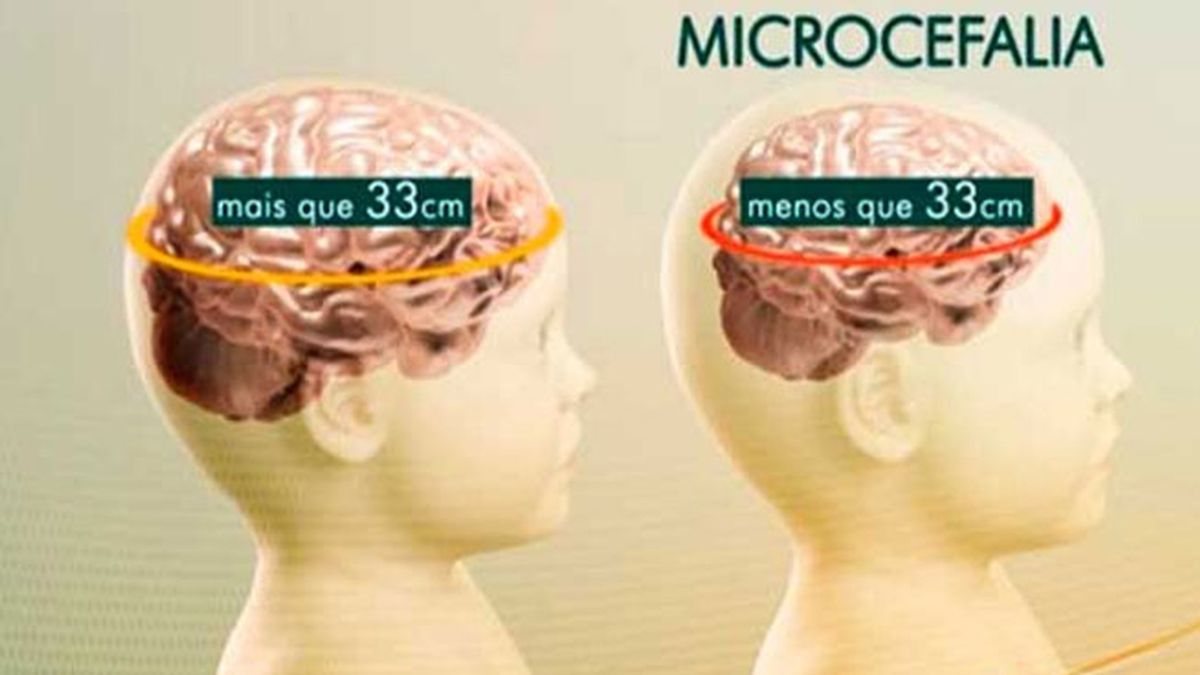 microcefalia,casos microcefalia Brasil,bebés microcefalia