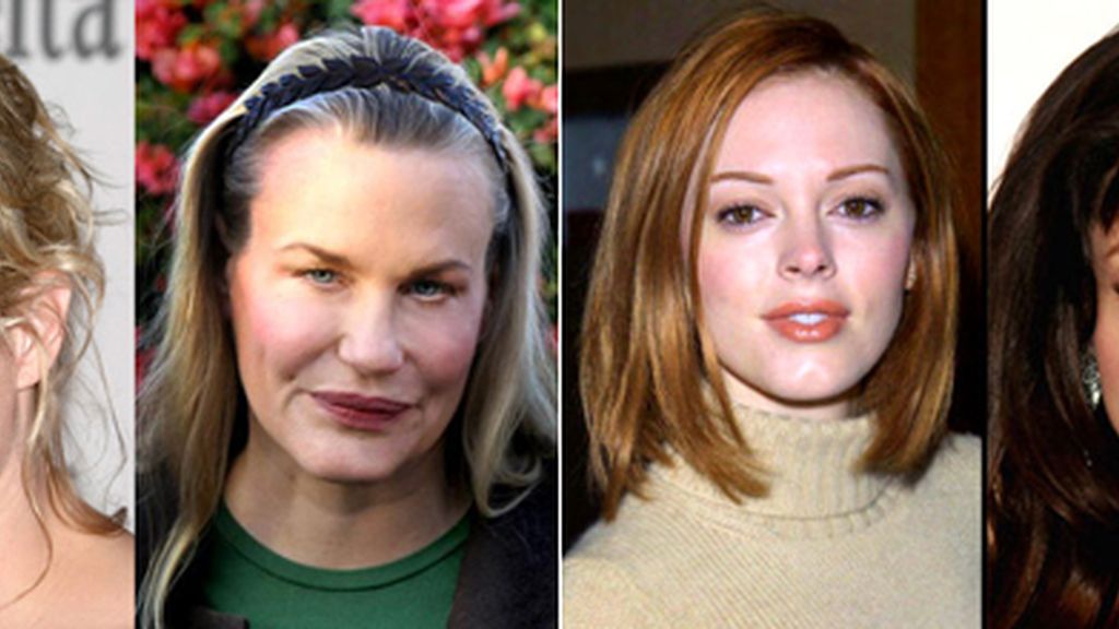 Botox