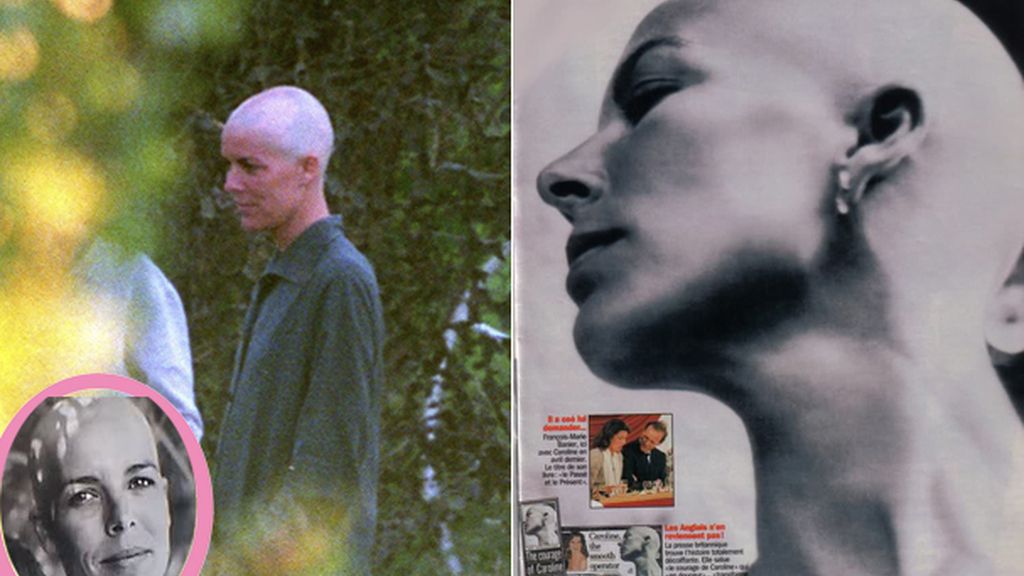 ALOPECIAVIP