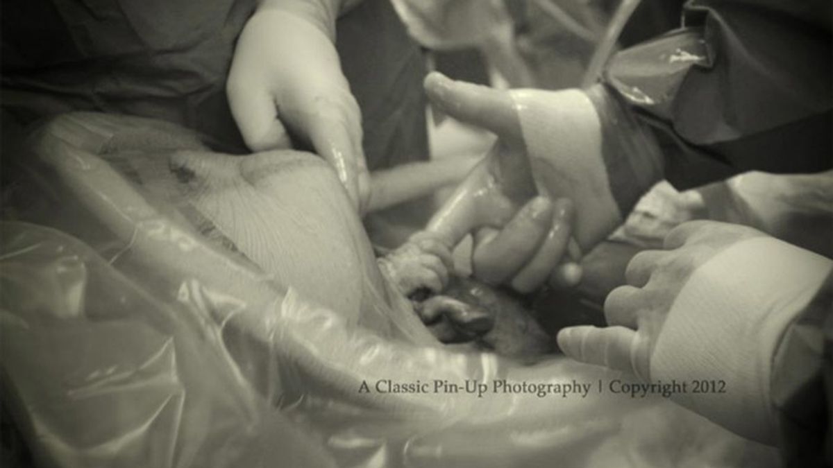 Un bebé agarra el dedo del cirujano que le trae al mundo durante una cesárea