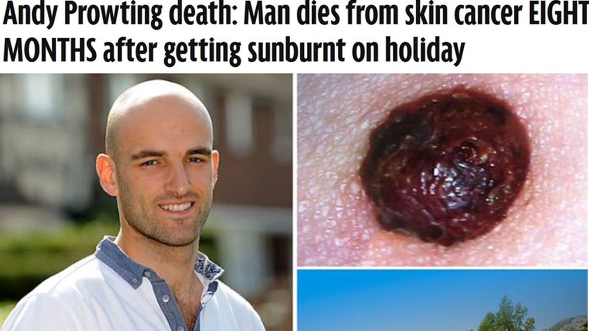 Fallece por cáncer de piel ocho meses después de quemarse con el Sol