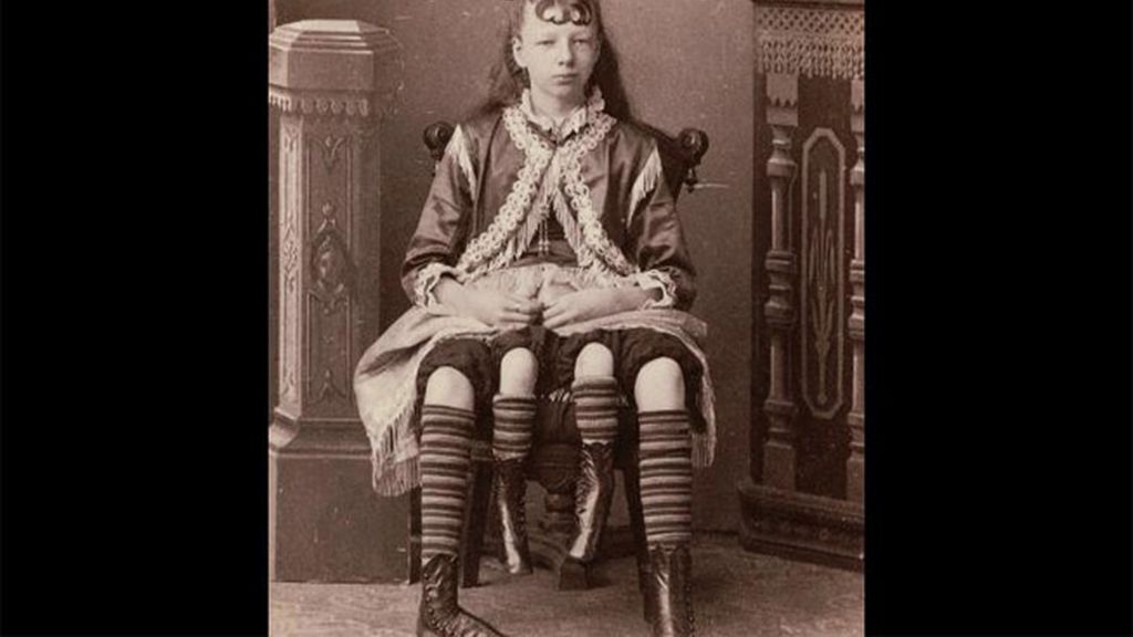 Myrtle Corbin, 'La Dama de cuatro piernas'