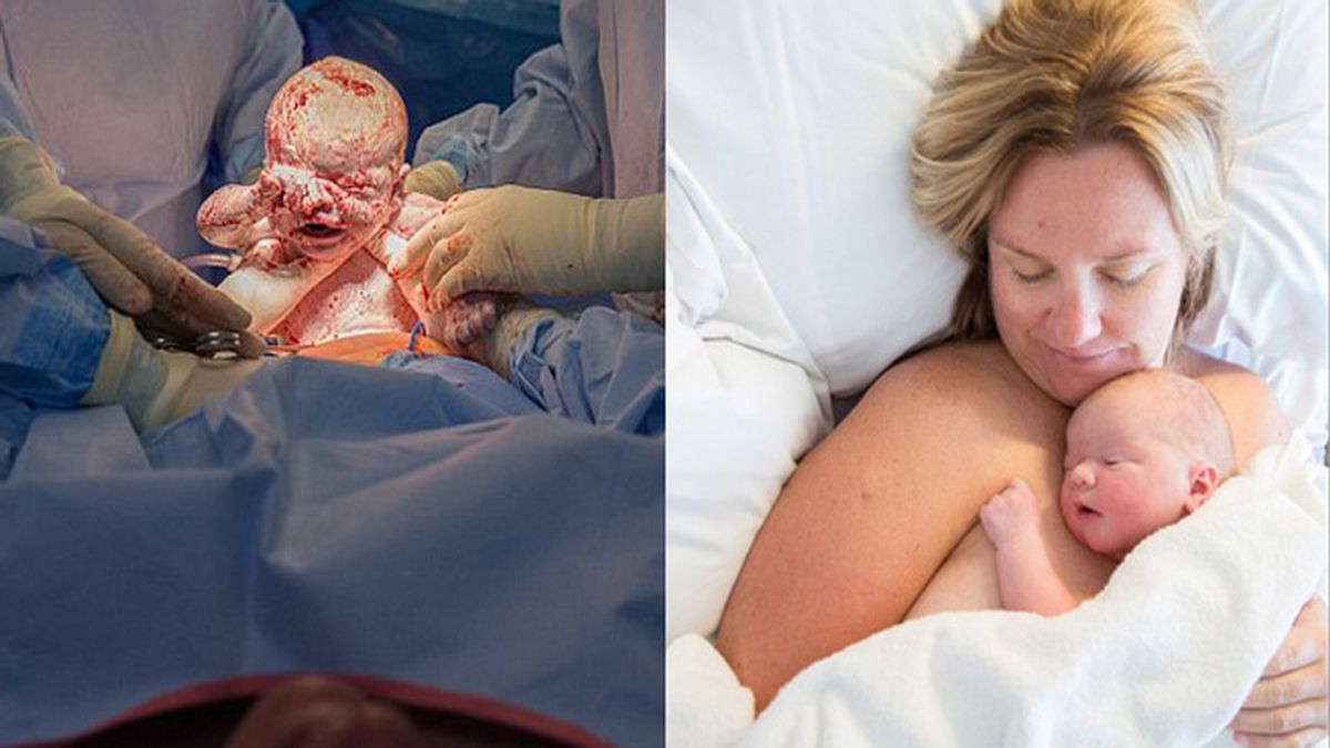 Una madre asiste su propio parto por cesárea