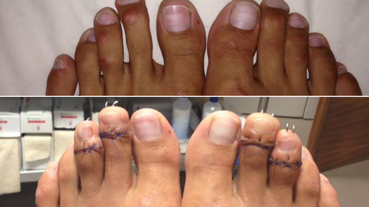 La nueva y peligrosa moda estética: acortarse los dedos de los pies