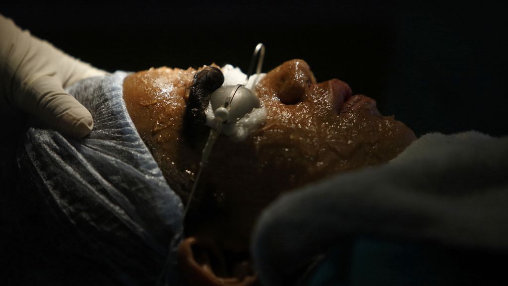 La hipertricosis les cubre todo el cuerpo de vello