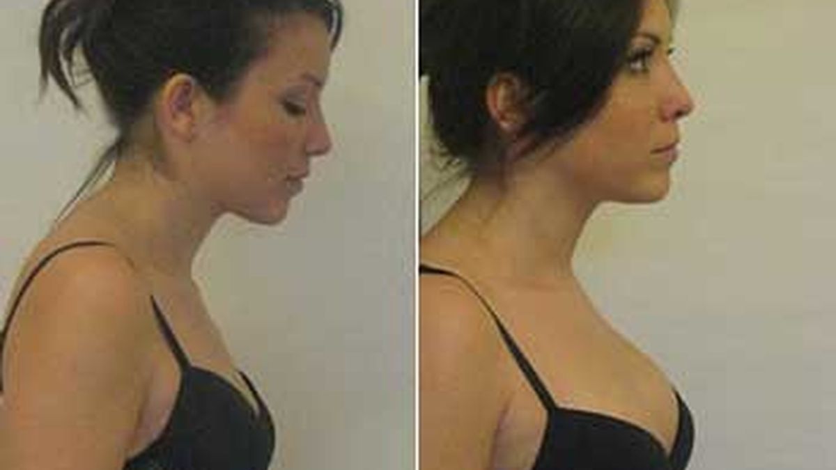Una de las pacientes de los doctores Viel posa antes y después de su aumento de pecho. Foto: Daily Mail