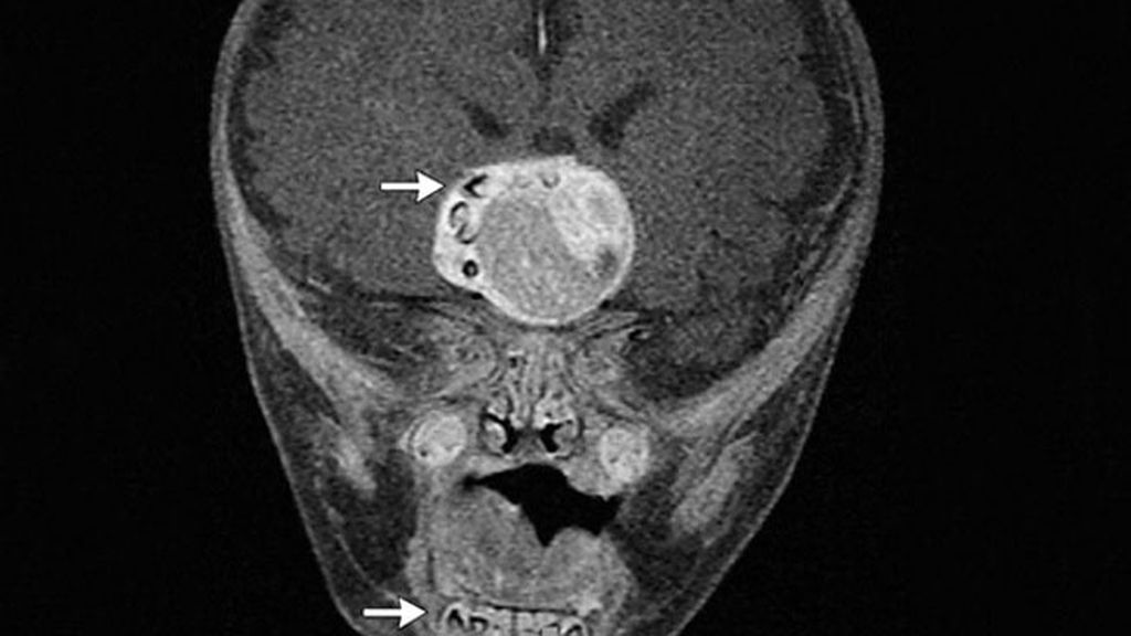 Hallan dientes en el cerebro de un bebé debido a un tumor poco frecuente Hallan dientes en el cerebro de un bebé debido a un tumor poco frecuente