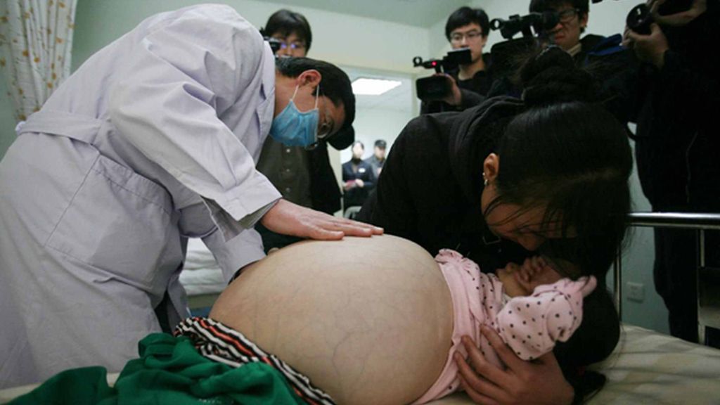 Padece una enfermedad que hincha su abdomen hasta límites extremos