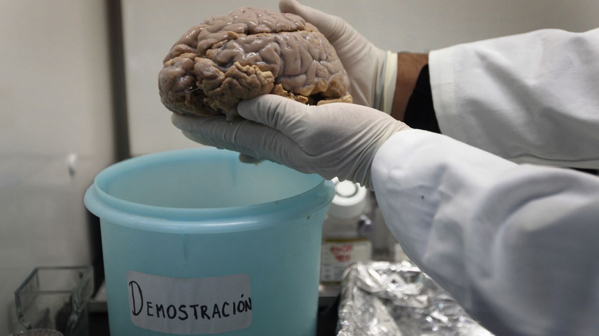 Un cerebro con Alzheimer, en Ciudad de México
