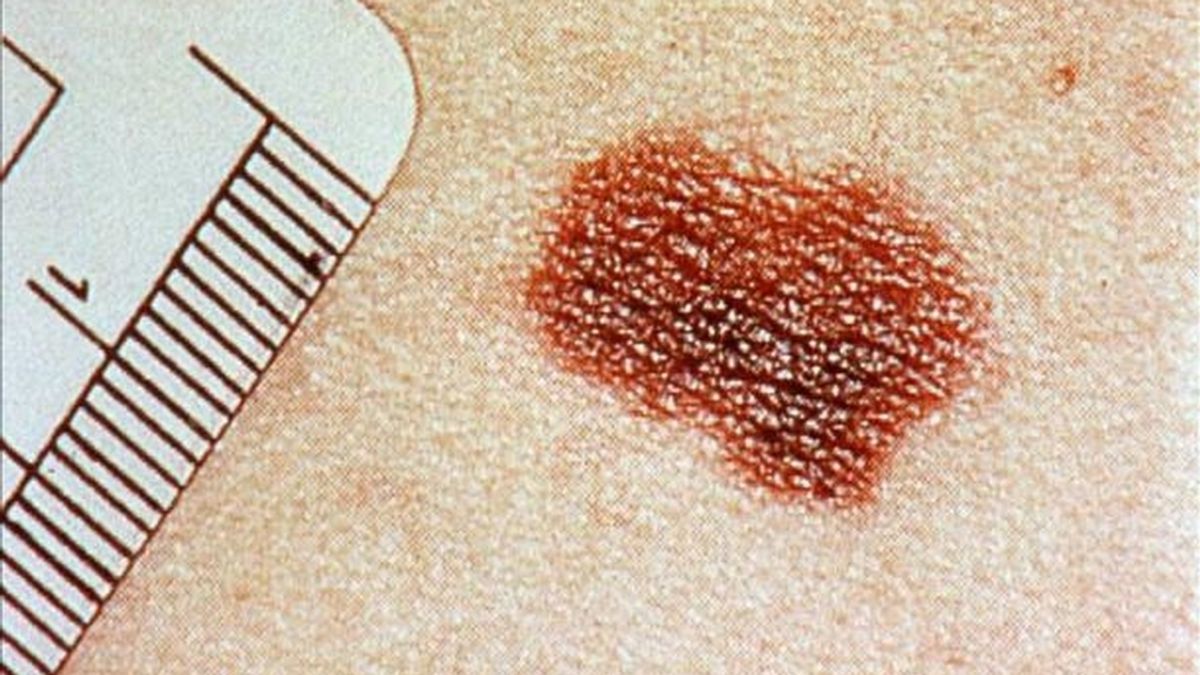 Los casos de melanoma aumentan un 3 y 8 por ciento cada año pero la mortalidad se mantiene