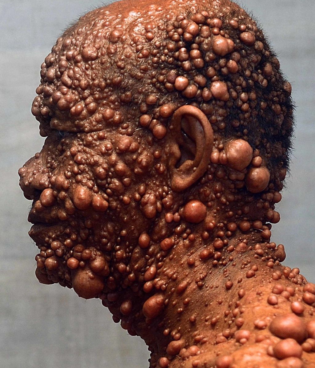 Devastado por tumores benignos