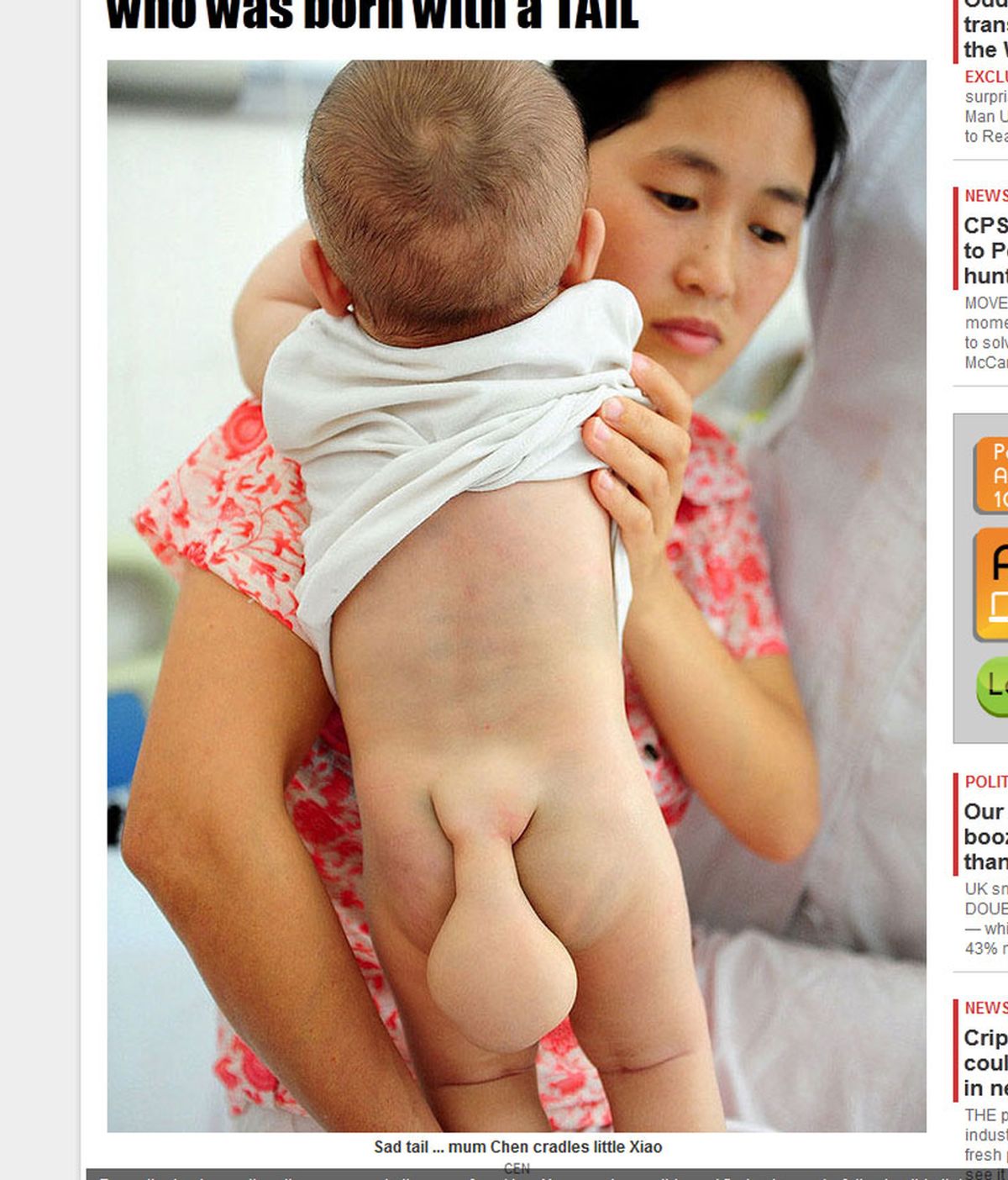 Niño chino con espina bífida. Foto: The Sun