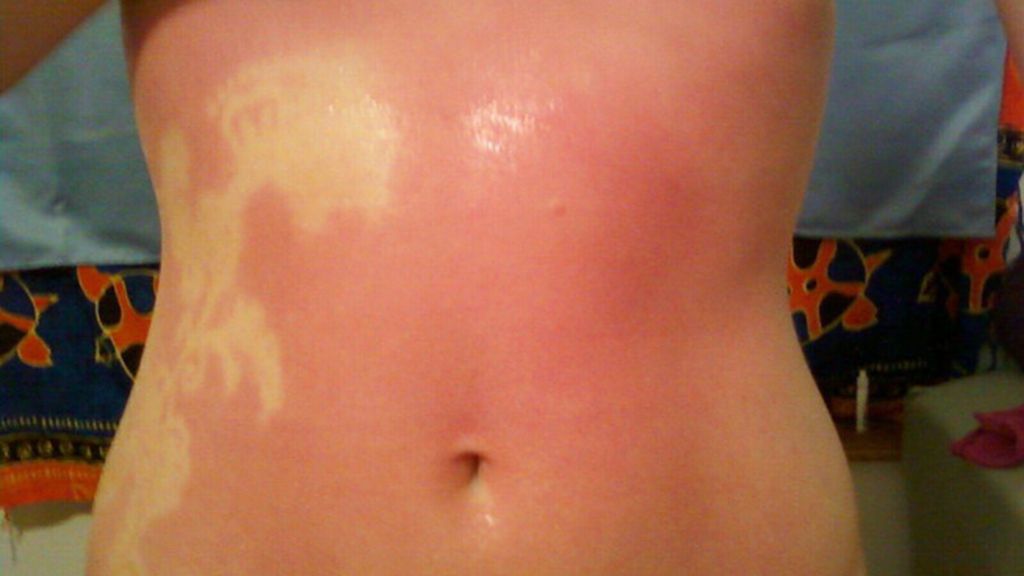 Sunburn Art, el arte de quemarse al sol