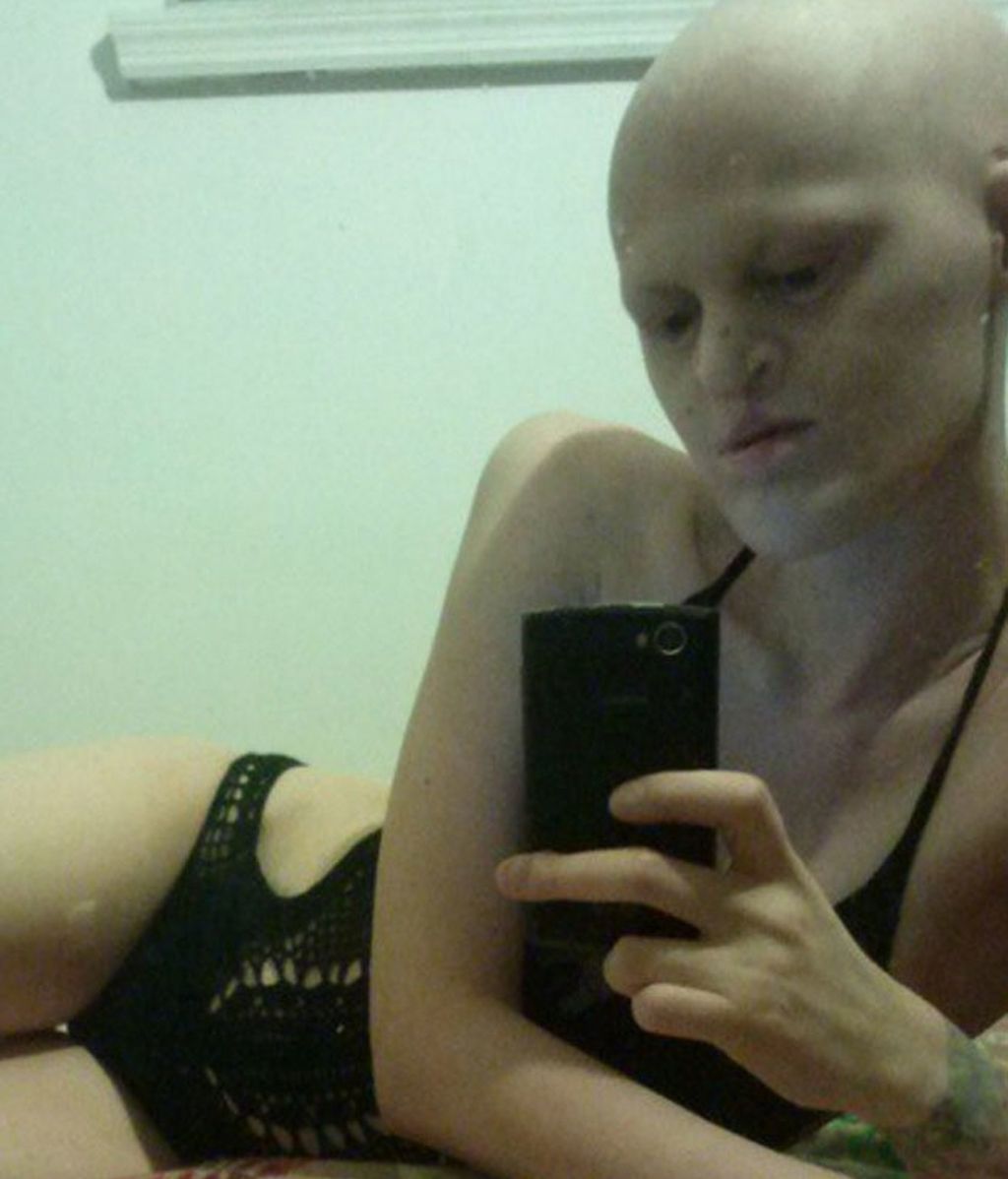 Melanie Gaydos, del complejo por su Displasia Ectodérmica a la pasarela