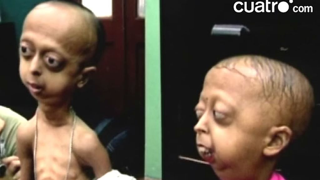 De siete hermanos, cinco han nacido con esta rarísima enfermedad