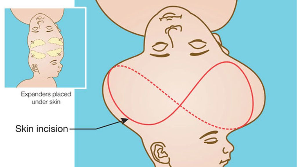 Maratón de 16 horas para separarlas