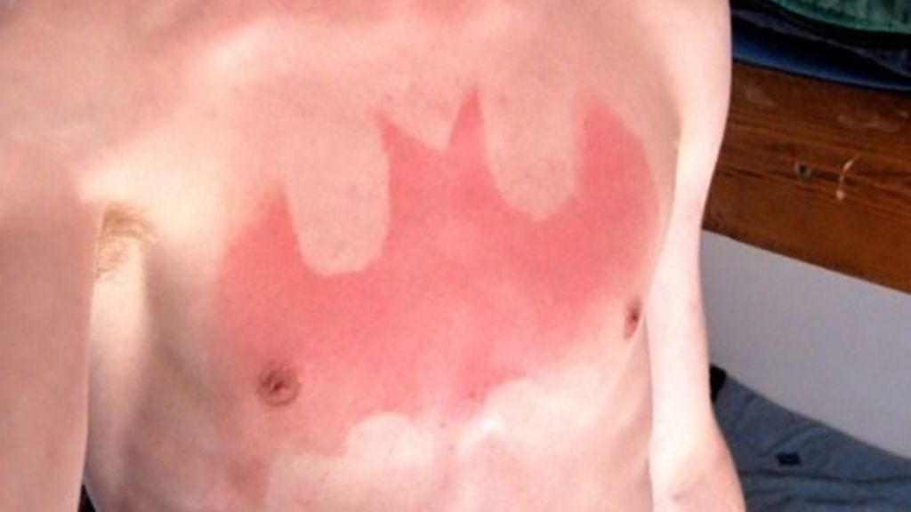Sunburn Art, el arte de quemarse al sol