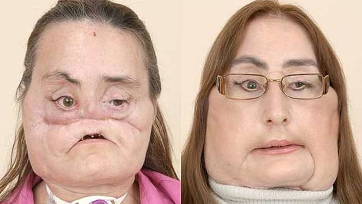 A Connie Culp le han trasplantado el 80% de su cara. Vídeo: Informativos Telecinco