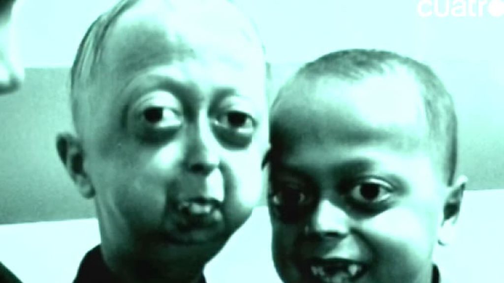 Los afectados de progeria pierden el pelo, sus huesos se debilitan y sufren 'achaques' típicos de la vejez. En contadas ocasiones superan los 21 años.