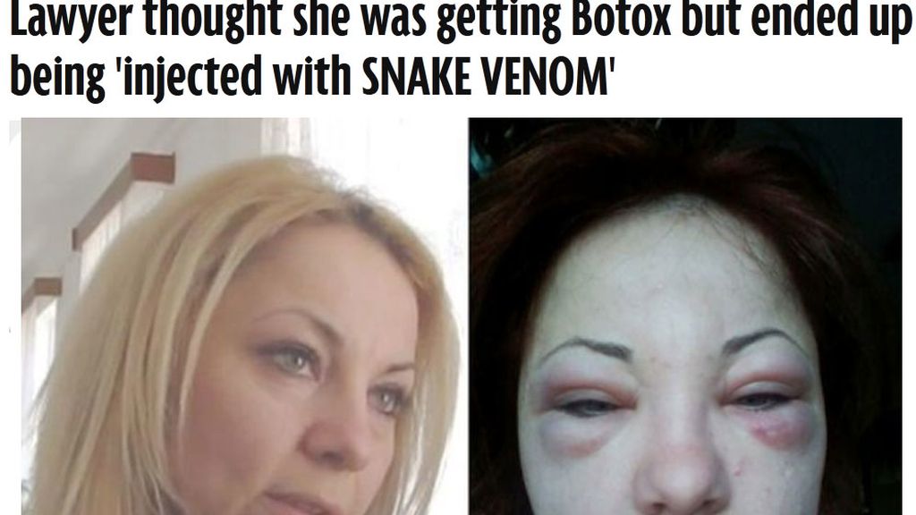 Le inyectan veneno de serpiente en una operación de Botox