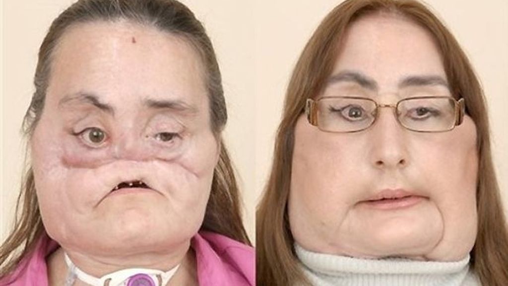 Connie Culp después de una treintena de operaciones ha vuelto a maquillarse a recomenzar su vida.