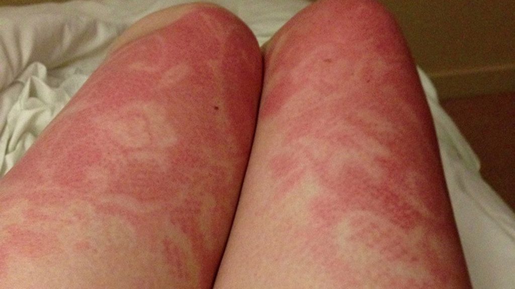 Sunburn Art, el arte de quemarse al sol