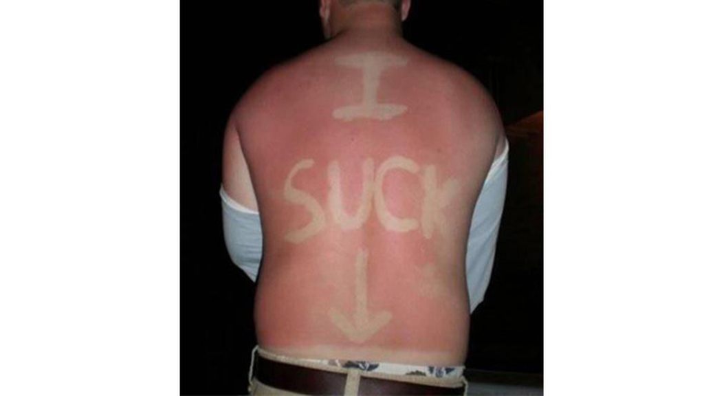 Sunburn Art, el arte de quemarse al sol