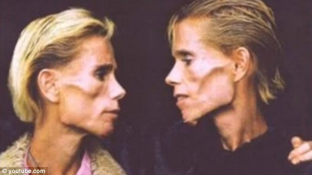 Las dos hermanas sufrían de anorexia desde la adolescencia cuando se obsesionaron con bajar de peso.
