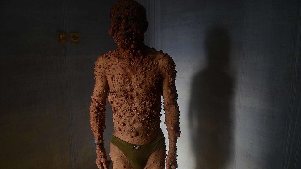 Devastado por tumores benignos