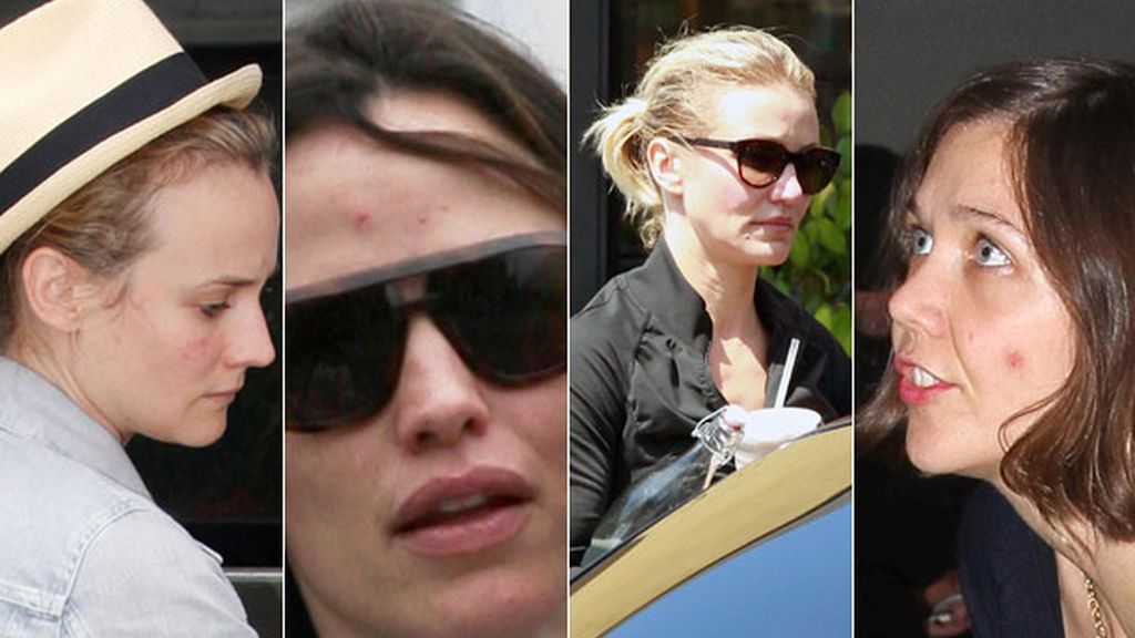 Los famosos también sufren con el acné