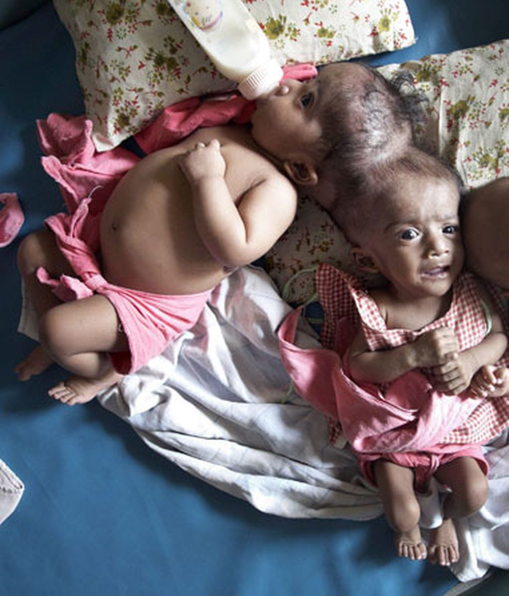 Maratón quirúrgico para separarlas